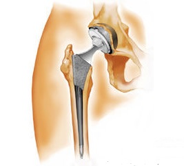 Hip Replacement