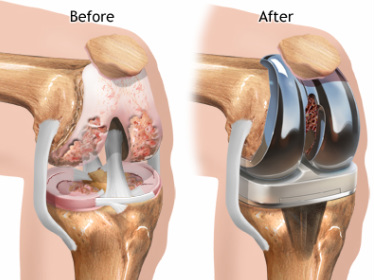 Hip-and-Knee-Replacement